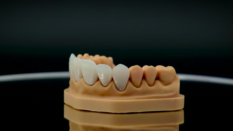 Dental Inlays and Onlays